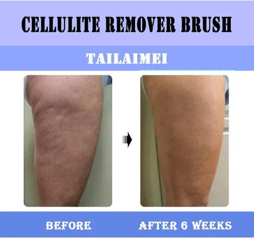 Vista 9 de TailaiMei Cepillo masajeador anticelulítico, limpiador de ducha corporal para removedor de celulitis, mejora la circulación, fascia, cepillo