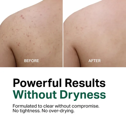 Vista 2 de Y'OUR Gel de baño antiacné de aloe vera Fórmula suave y no seca Suaviza la textura y unifica el tono Limpia el bacne y los brotes para mujeres