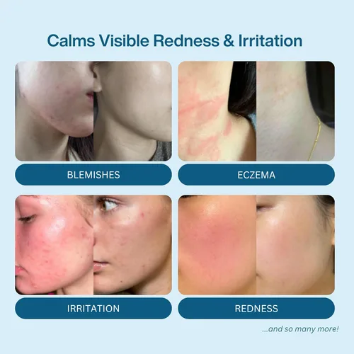 Vista 3 de Spray de ácido hipocloroso – Limpiador facial HOCl probado por dermatólogos para pieles sensibles, propensas al acné e irritadas – Alivia