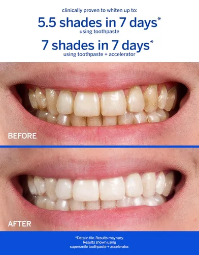 Vista 2 de Supersmile Acelerador de blanqueamiento profesional, potente blanqueamiento sin sensibilidad, seguro y eficaz en restauraciones dentales (3.6 onzas)