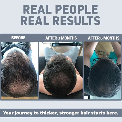 Vista 7 de Herbtonics Gomitas de colágeno múltiple tipo 1, 2, 3, 5 y 10 con biotina para el crecimiento del cabello, la piel, las uñas, bloqueador de DHT