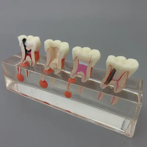Vista 6 de Modelo de dientes dentales Modelo de tratamiento endodóntico de 4 etapas para estudiar y enseñar..