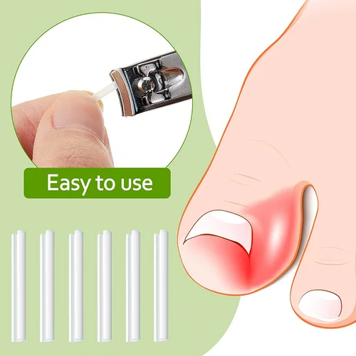 Vista 6 de Tiras correctoras de uñas encarnadas profesionales, 50 tiras correctoras de uñas encarnadas, tiras curvadas para enderezar las uñas del pie, clips