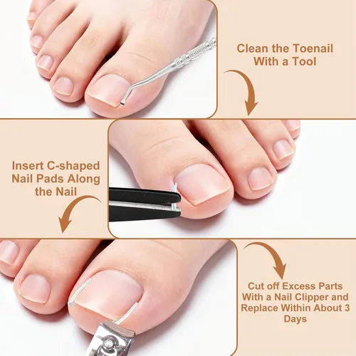 Vista 6 de Juego de corrector de uñas encarnadas con tiras correctoras – Kit de herramientas profesionales para uñas de los pies que incluye tiras