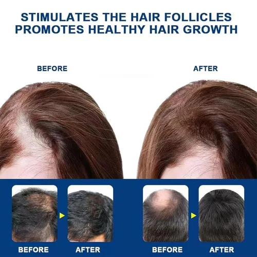 Vista 3 de 5% Minoxidil Hair Growth for Men and Women,Minoxidil Hair Growth Serum,Fast Regrowth & Strengthens Hair Roots,for Thinning Hair Loss to Grow Thicker