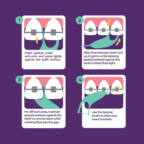 Vista 4 de Platypus Hilo dental ortodóntico para brackets, 30 unidades (paquete de 1), palillos ortodónticos para adultos y niños, se adapta debajo del alambre