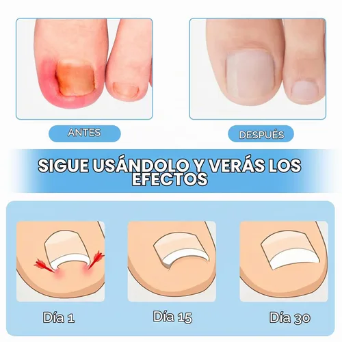 Vista 2 de Kit de eliminación de uñas encarnadas con tiras de uñas encarnadas, parche corrector de uñas curvas, lima de uñas y herramientas de pedicura
