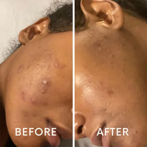 Vista 2 de Hidratante facial hidratante con ácido hialurónico y aloe – Crema facial diaria ligera para pieles secas, grasas, mixtas, maduras y sensibles