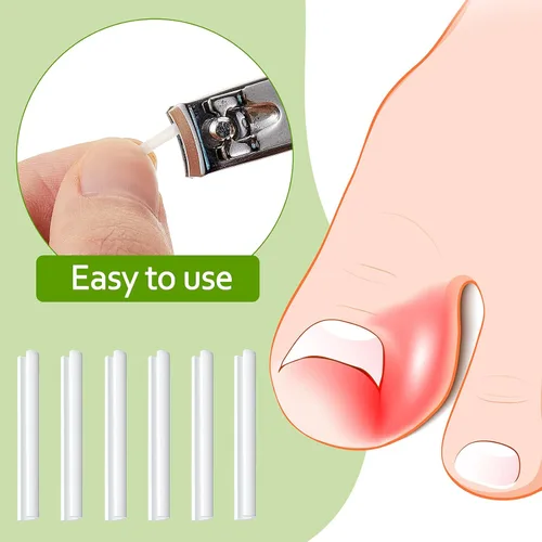 Vista 2 de 100 tiras correctoras de uñas encarnadas, parches de corrección de uñas de los pies, parches curvos para enderezar las uñas de los pies, clips
