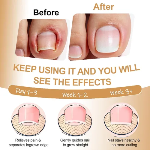 Vista 3 de Kit de eliminación y corrector de uñas encarnadas para un alivio rápido del dolor, kit profesional de tratamiento de uñas encarnadas con tiras