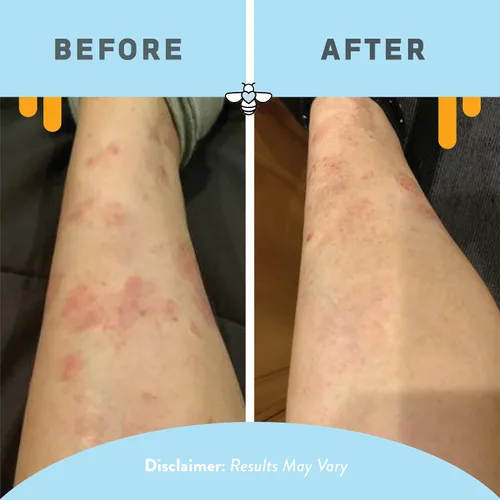 Vista 5 de PSORIASIS HONEY Loción corporal hidratante diaria, crema para eccema y dermatitis seborreica para picazón y descamación, tratamiento hidratante