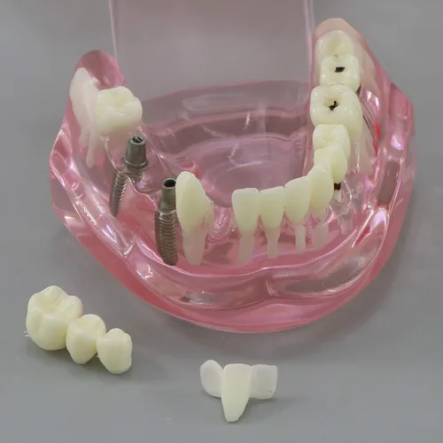 Vista 9 de Demostración oral del puente de la patología del color rosado de los dientes de Typodont de la restauración del implante dental M2001