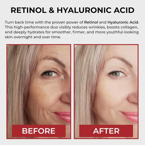 Vista 2 de AURA - Suero de retinol antienvejecimiento 1% - Retinol encapsulado, ácido hialurónico, vitamina C y E, colágeno, niacinamida, paquete económico