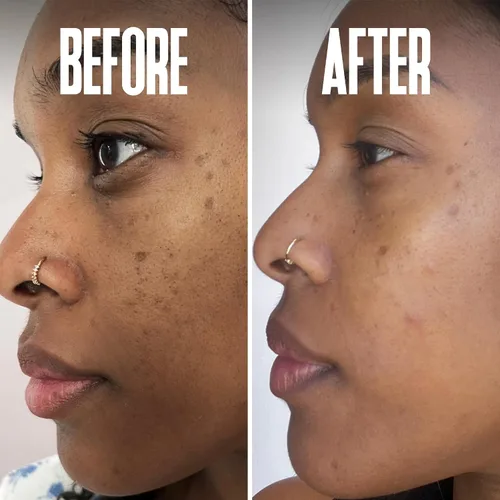 Vista 9 de Eliminador corrector de puntos oscuros de hidroquinona 2% para el tratamiento facial y melasma, contiene vitamina C, ácido salicílico, ácido kójico