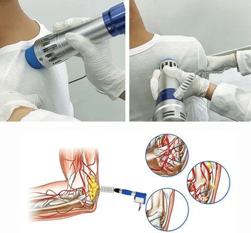 Vista 5 de Máquina extracorpórea de la terapia de la onda de choque, masajeador profundo del músculo de la onda de choque para el músculo del alivio del dolor