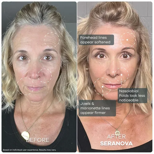 Vista 5 de Seranova Micro Infusión para el Cuidado de la Piel, Esencia Hidratante Facial, Suero Facial para una Piel Lisa para Todos los Tipos de Piel
