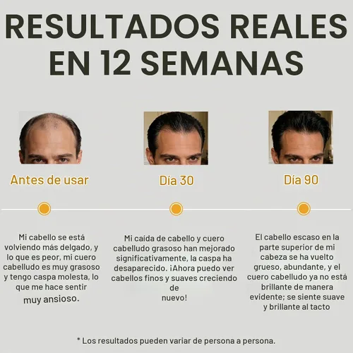 Vista 7 de Champú, champú de cebolla para el crecimiento del cabello, con aceite de romero, cebolla roja, canela, previene eficazmente la pérdida de cabello