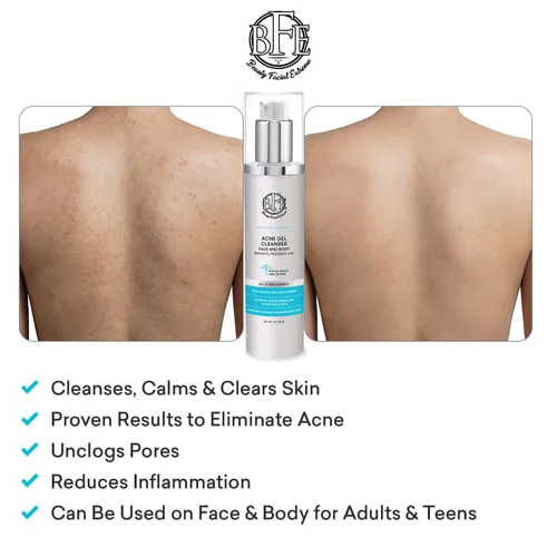 Vista 6 de Tratamiento de lavado facial para acné con peróxido de benzoilo – Combate las imperfecciones del acné al contacto para brotes quísticos, piel grasa