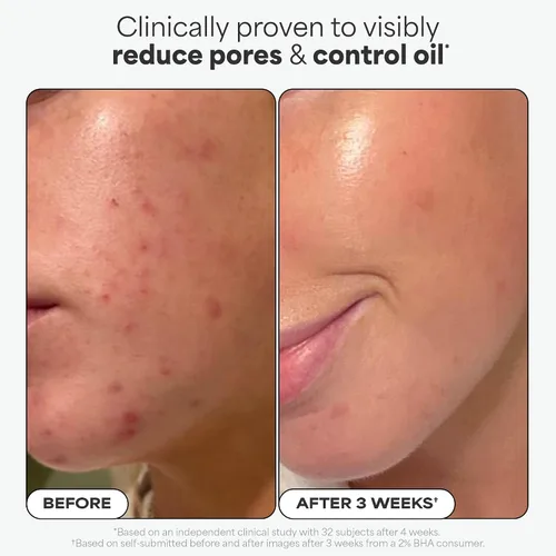 Vista 5 de Paula's Choice Skin Perfecting - Exfoliante líquido de ácido salicílico BHA al 2 %