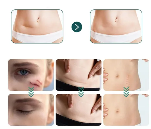 Vista 6 de Losveo - Hojas de silicona para cicatrices para arrugas faciales, tiras de cinta de colágeno de 1.6 x 60 pulgadas para cicatrices faciales, láminas