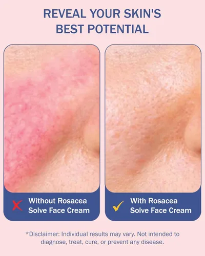 Vista 5 de Tratamiento para rosácea para el cuidado de la piel facial en crema para mujeres y hombres (paquete de 2) - Hidratante suave que reduce