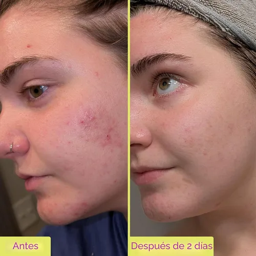 Vista 3 de Good Molecules Tratamiento de 10% de ácido azelaico para la cara – Fórmula calmante para el enrojecimiento facial y el tono desigual – Ilumina
