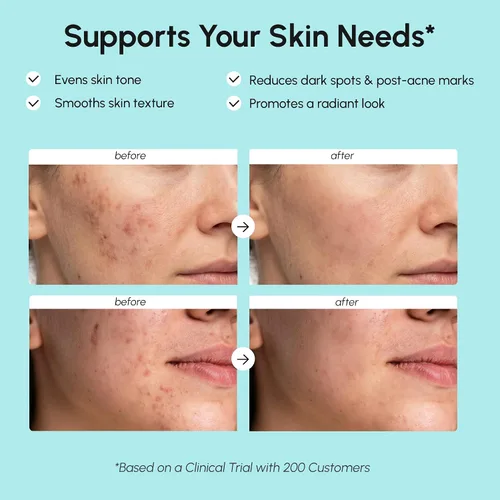 Vista 9 de MAREE Crema facial de ácido azelaico - Tratamiento de ácido azelaico con niacinamida y ácido salicílico - Corrector de manchas oscuras para la cara