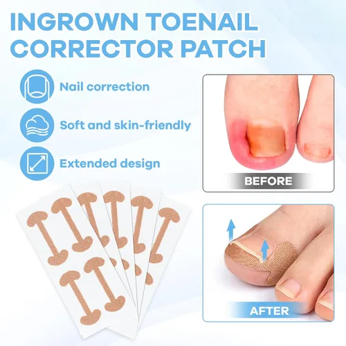 Vista 3 de Kit de eliminación de uñas encarnadas con tiras de uñas encarnadas, parche corrector de uñas curvas, lima de uñas y herramientas de pedicura