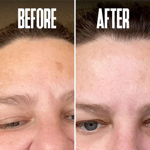 Vista 6 de Eliminador corrector de puntos oscuros de hidroquinona 2% para el tratamiento facial y melasma, contiene vitamina C, ácido salicílico, ácido kójico