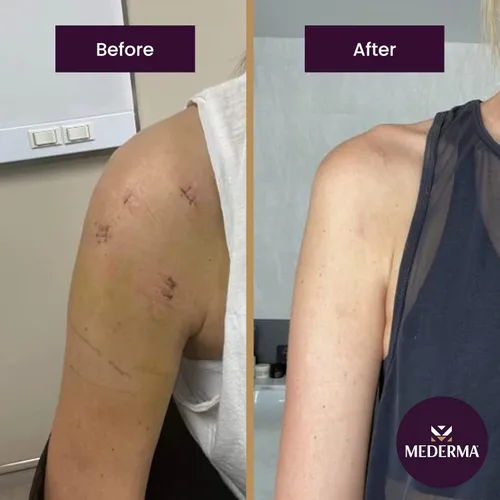 Vista 3 de Mederma Gel de cicatriz avanzado de secado rápido con aceite para cicatrices y estrías