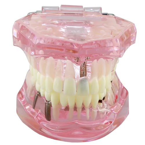 Vista 3 de Demostración oral del puente de la patología del color rosado de los dientes de Typodont de la restauración del implante dental M2001