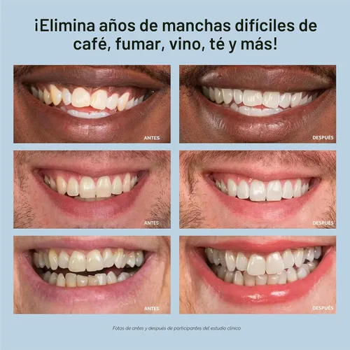 Vista 7 de Kit blanqueador de dientes, luz de LED, peróxido de carbamida del 35 %, (2) jeringuillas del gel 0.17 onzas líquidas, bandeja