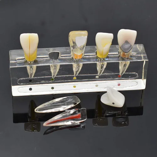 Vista 5 de Modelo patológico de restauración de pulpa dental de diente frontal, modelo endodóntico humano