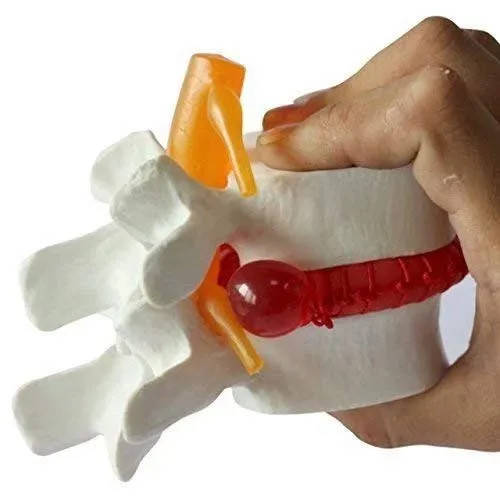 Vista 3 de Modelo de demostración de hernia de disco lumbar humana Modelo anatómico de la columna vertebral humana Amarillo