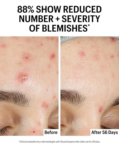 Vista 5 de Allies of Skin Suero aclarante facial azelaico y kójico Clínicamente probado para piel propensa al acné y a las imperfecciones 10% ácido