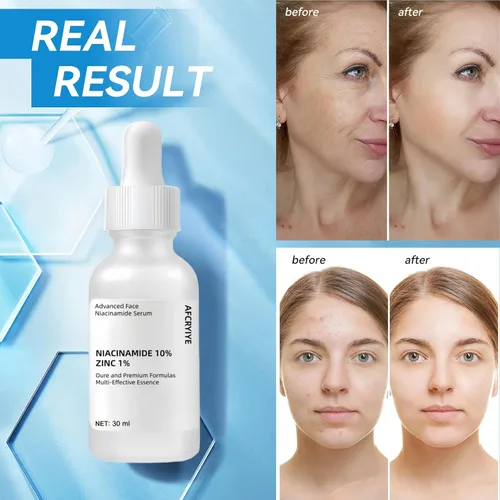 Vista 11 de Niacinamida 10% + Zinc 1% suero para la cara – Control de aceite, acné, reductor de poros y reducción de imperfecciones – Suero facial ligero,