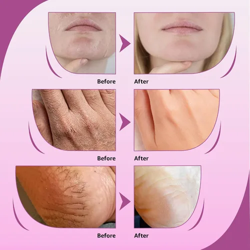 Vista 6 de Crema 10% de urea con aloe vera, aceite de jojoba y ácido salicílico, 5.1 fl oz hidratante para manos, pies, cara y cuerpo secas y agrietadas