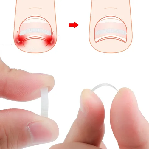 Vista 6 de 60 tiras correctoras de uñas encarnadas, corrección de uñas encarnadas, corrección de uñas, clip para enderezar uñas, parche curvo corrector de uñas