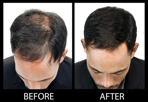 Vista 7 de Fibras capilares voluminizadoras con queratina real para adelgazar el cabello/pérdida de cabello – Dermatológicamente probado y certificado