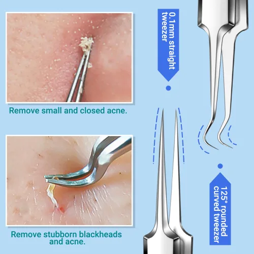Vista 3 de TsMADDTs Extractor de espinillas, herramienta de tratamiento de acné, kit de eliminación de comedones para manchas, puntos blancos, kit