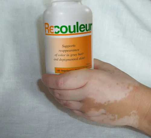 Vista 5 de Suplemento vitamínico y mineral de vitíligo para la mancha blanca y la pigmentación de la piel - Suministro para 6 meses - Terapia de tratamiento