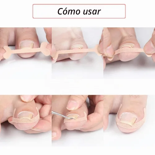 Vista 4 de EBANKU Tiras de tratamiento de uñas encarnadas, 20 piezas de parche de corrección de uñas de los pies, parche elástico, corrector de pedicura