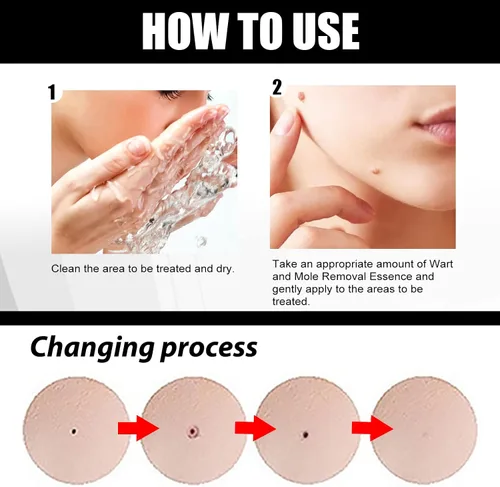 Vista 5 de Suero eliminador de verrugas profesional con ácido salicílico, para verrugas comunes en pies, manos y cuerpo, formulado con glicerina y pantenol(1)