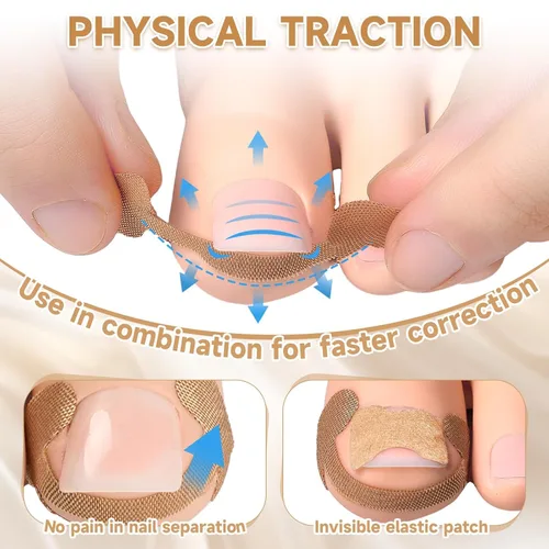 Vista 5 de Kit corrector de uñas encarnadas de 201 piezas con tiras de corrección transpirables, parches de uñas curvas, herramientas levantadoras de uñas