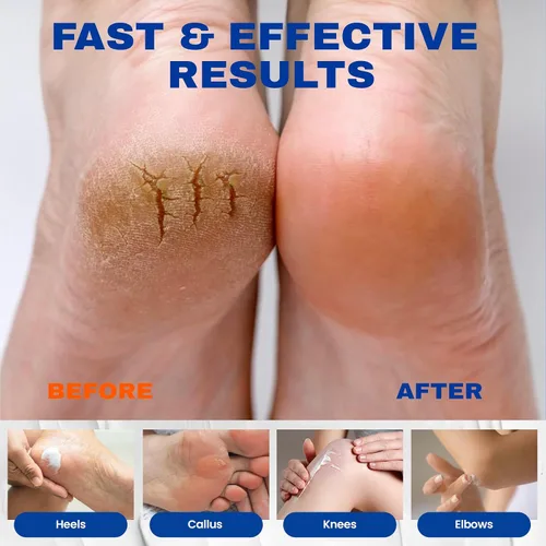 Vista 3 de SKIN ULTIMA Crema de urea 40 porciento más 2% ácido salicílico, 40% crema de urea para pies de máxima potencia, crema de pies para pies secos