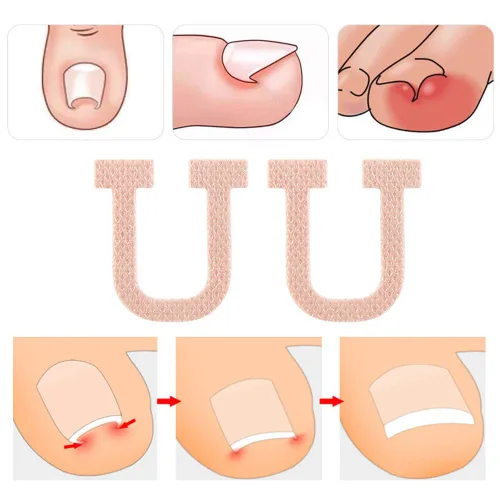Vista 4 de Paquete de 40 parches correctores de uñas encarnadas en forma de U, correctoras de uñas de los pies, parches de corrección, vendajes para alivio