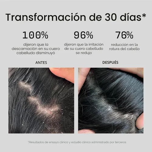Vista 2 de Jupiter Champú Anticaspa - Champú para hombres y mujeres para cuero cabelludo escamoso, con picazón, graso y seco - Nutre el cuero cabelludo