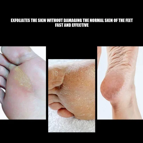 Vista 5 de Broca de cono de pedicura, pedicura de acero inoxidable, pedicura, callos de pie, lijado, cabeza, pies, limar las uñas para pulir y reparar la piel