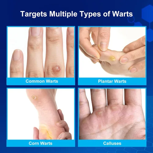 Vista 3 de Fast-Acting Wart Remover Freeze Off & Corn Remover, 2-Pack 30 ml Salicylic Acid Plantar Wart Remover for Feet, Hands & Skin - Professional Wart