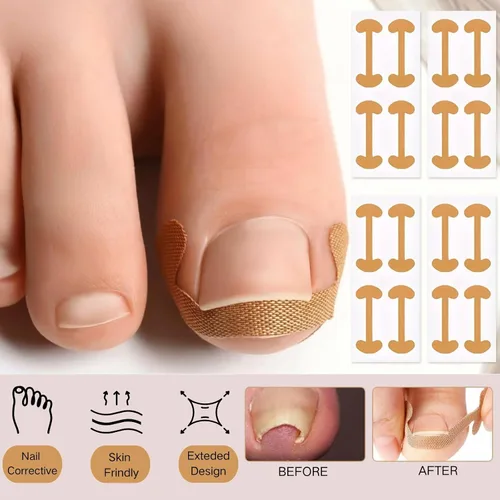 Vista 3 de Juego de corrector de uñas encarnadas con tiras correctoras, juego de herramientas profesionales de pedicura para uñas encarnadas con lima